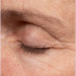 Thermage Before & After Patient #1590